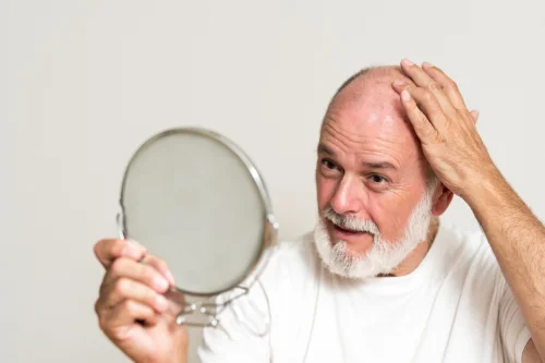 Mann mit Haarausfall blickt in den Spiegel