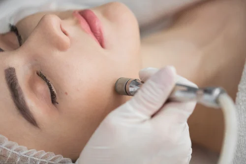 Mikrodermabrasion bei einer Frau im Gesicht