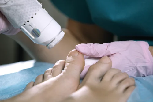 Lasertherapie bei Nagelpilz