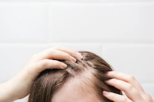 Kopfhaut mit Haarausfall