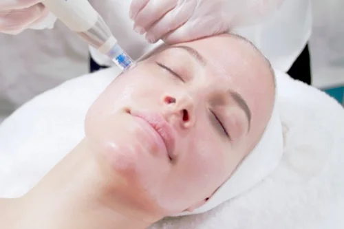 MIcroneedling-Behandlung im Gesicht einer Frau